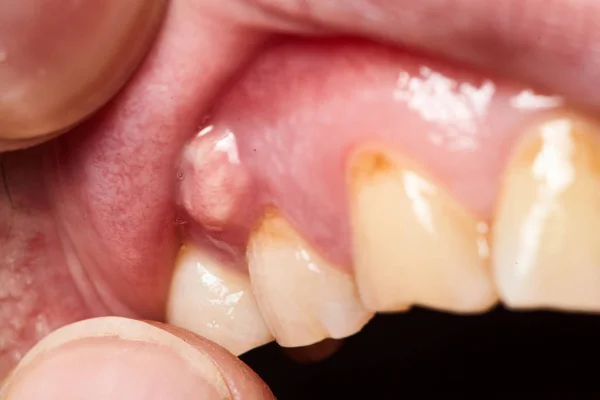 Close-up of a tooth infection with visible abscess on the gums. Home remedies for an infected tooth can help reduce pain and swelling temporarily.