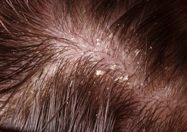 "Close-up of a dry scalp with visible flakes, showing symptoms of dryness and irritation. This image represents a common issue addressed by natural remedies for dry scalp, such as moisturizing treatments like coconut oil and aloe vera.